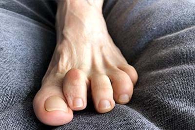 Hammertoes and Their Causes